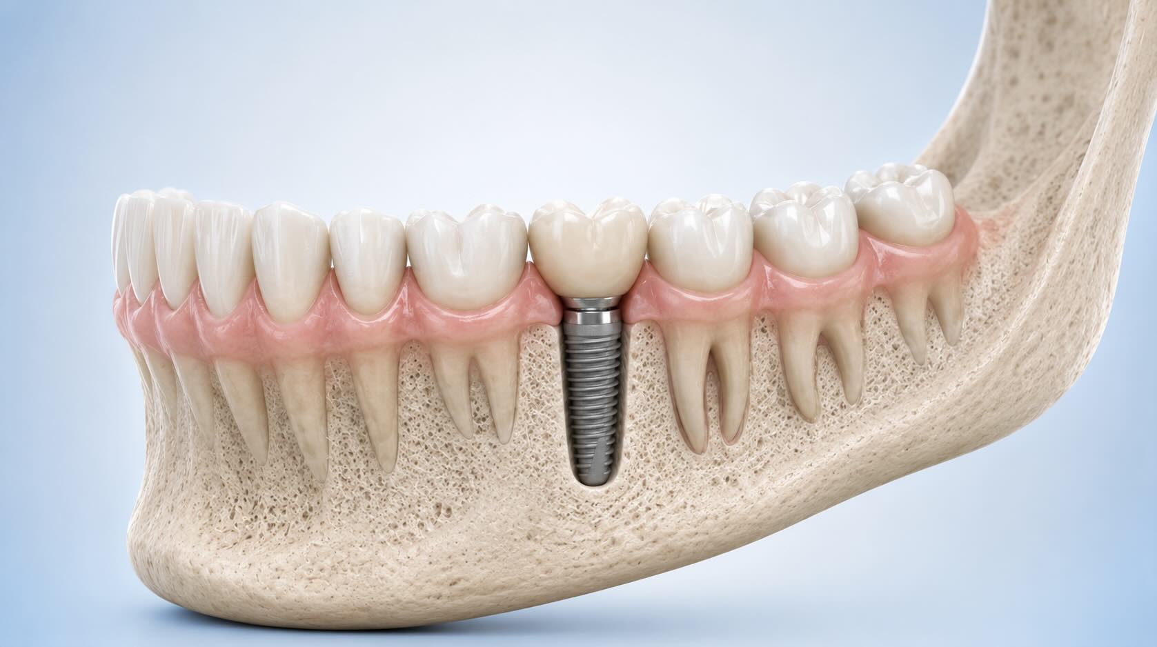 implantes individuales en Cancún, por el Dr. Rafael Hernández